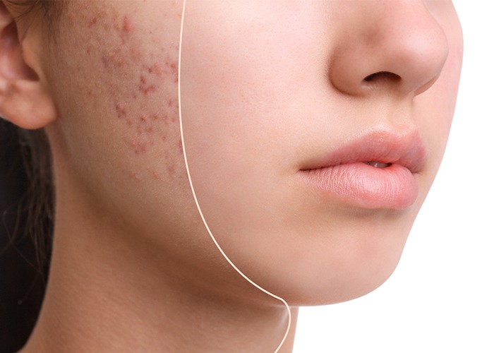 Acne Scar Treatment in Delhi